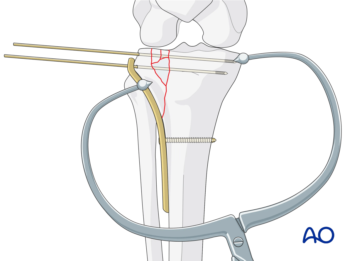 Proximal tibia Lateral plateau split-depression fracture – ORIF conventional plating – plate location