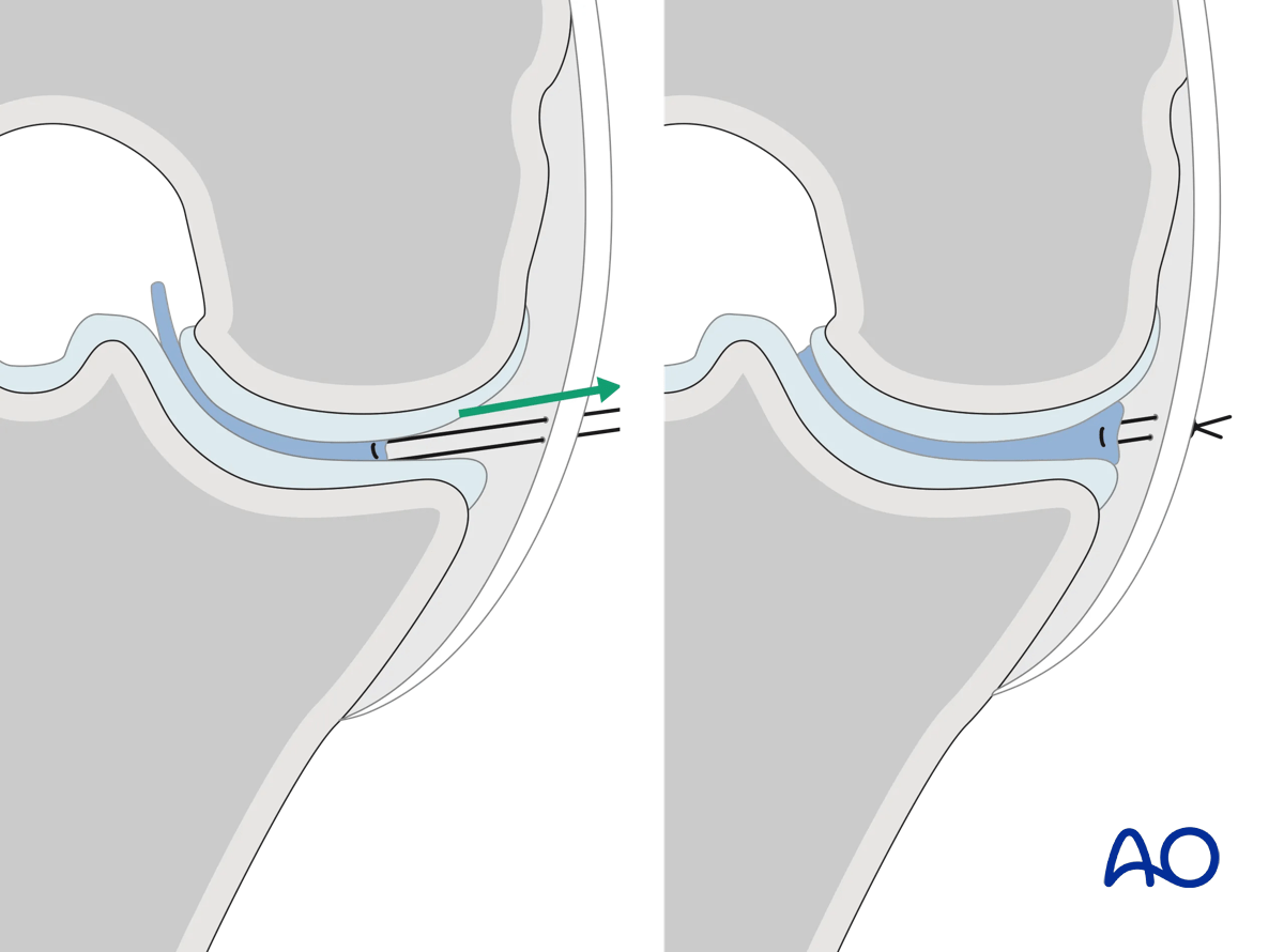 ORIF - Conventional plating, final osteosynthesis