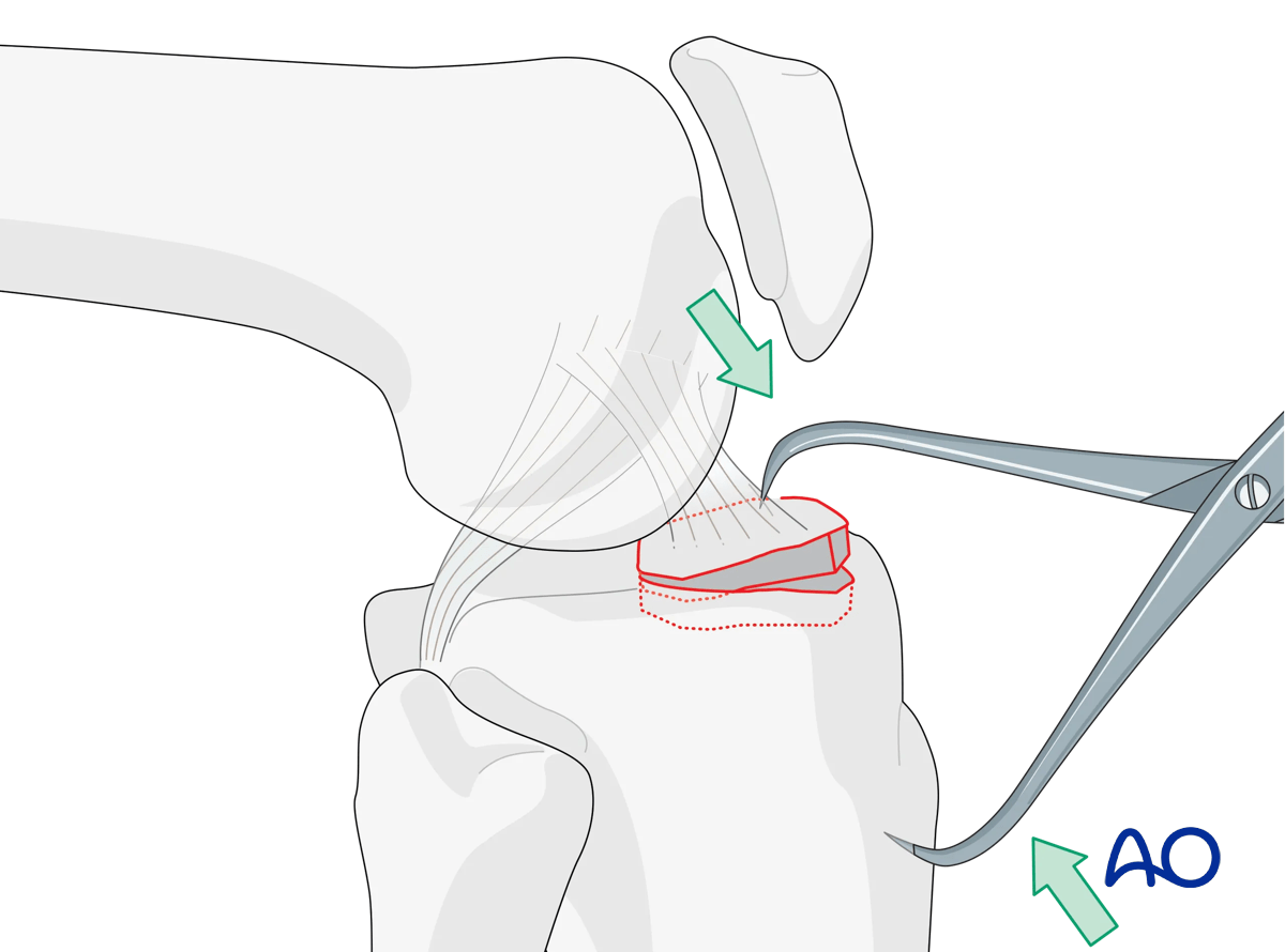Extraarticular fracture, avulsion of tibial spine – reduction