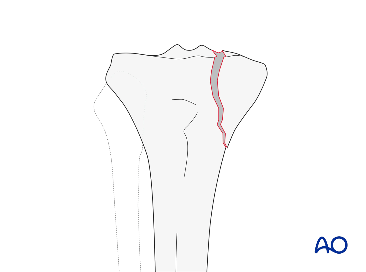 Split of the medial surface (AO/OTA 41B1.2)