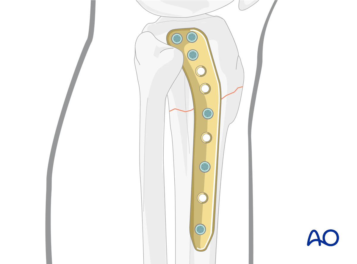 Proximal tibia: Simple extraarticular fracture of the metaphysis Angular stable plating