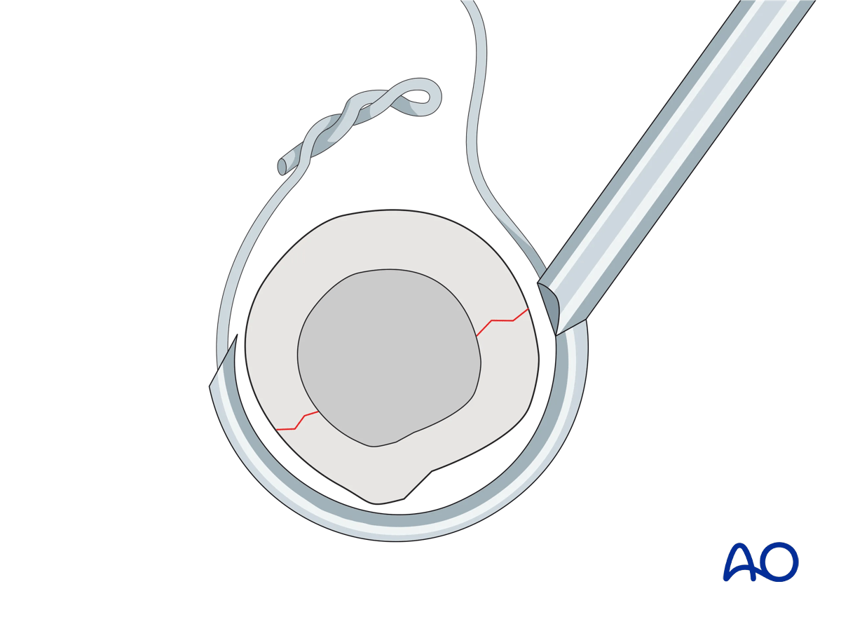 The cerclage wire is placed around the bone using a wire passer.