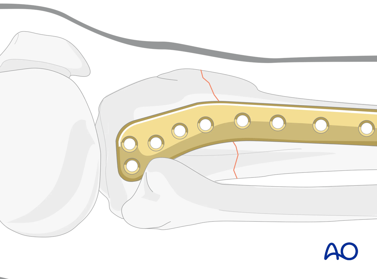 Proximal tibia: Simple extraarticular fracture of the metaphysis Angular stable plating – positioning of the plate