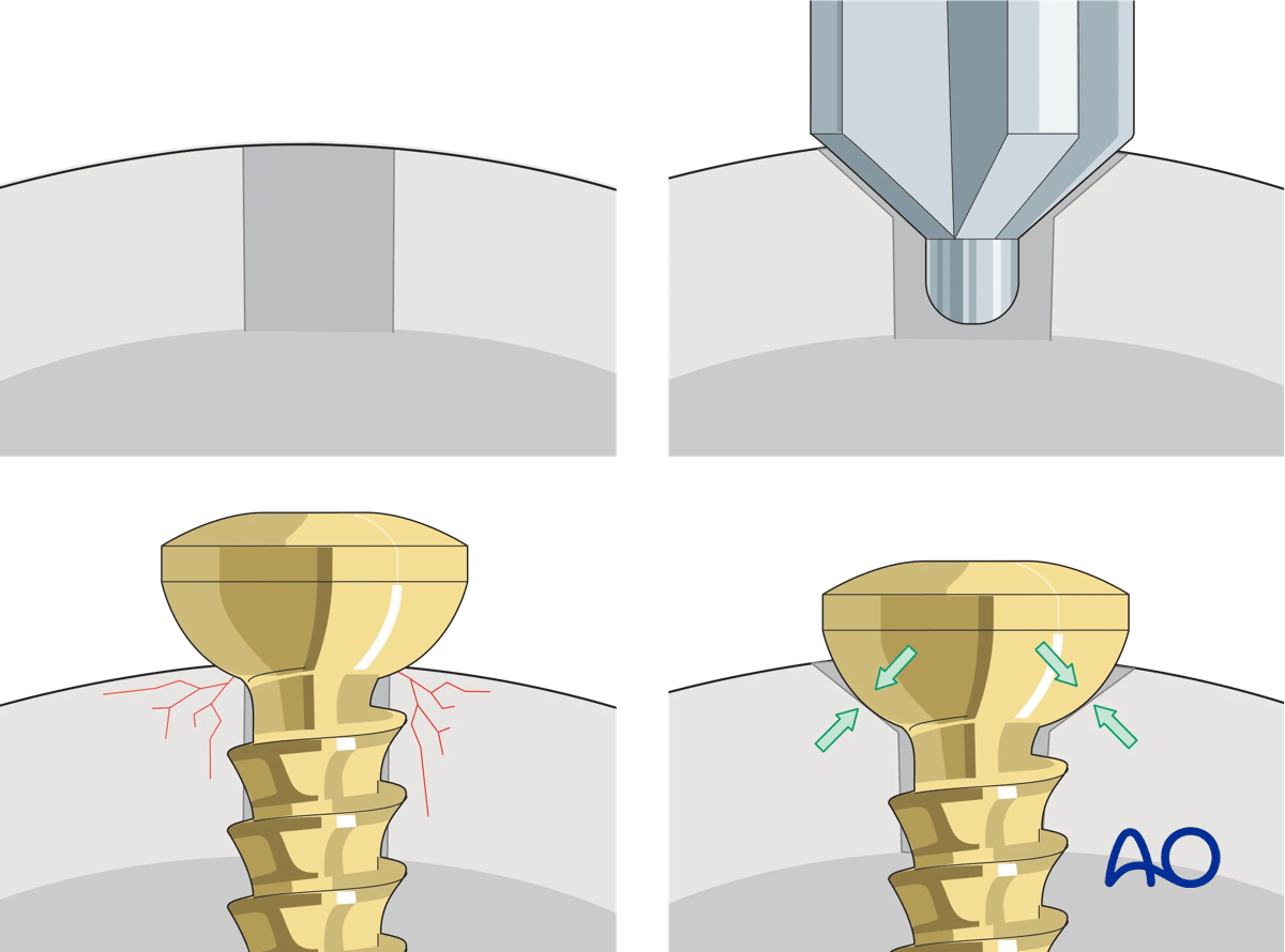 Proximal tibia: Countersinking