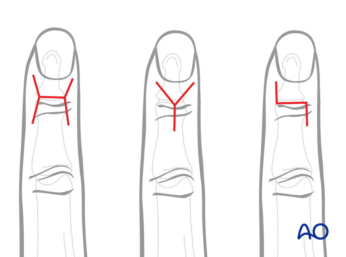 Dorsal approach to the DIP joint