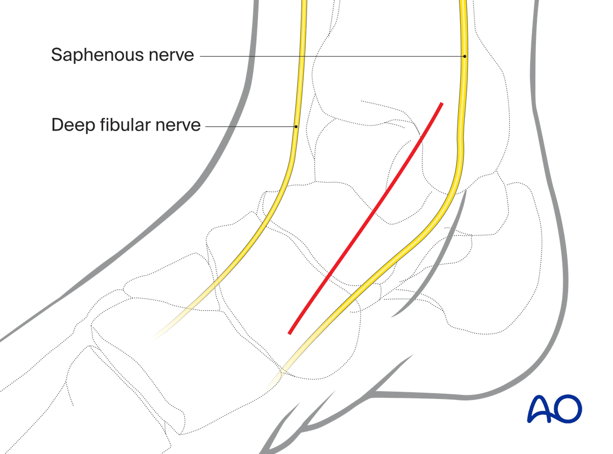Anteromedial approach incision line from medial malleolus extending distally to the navicular