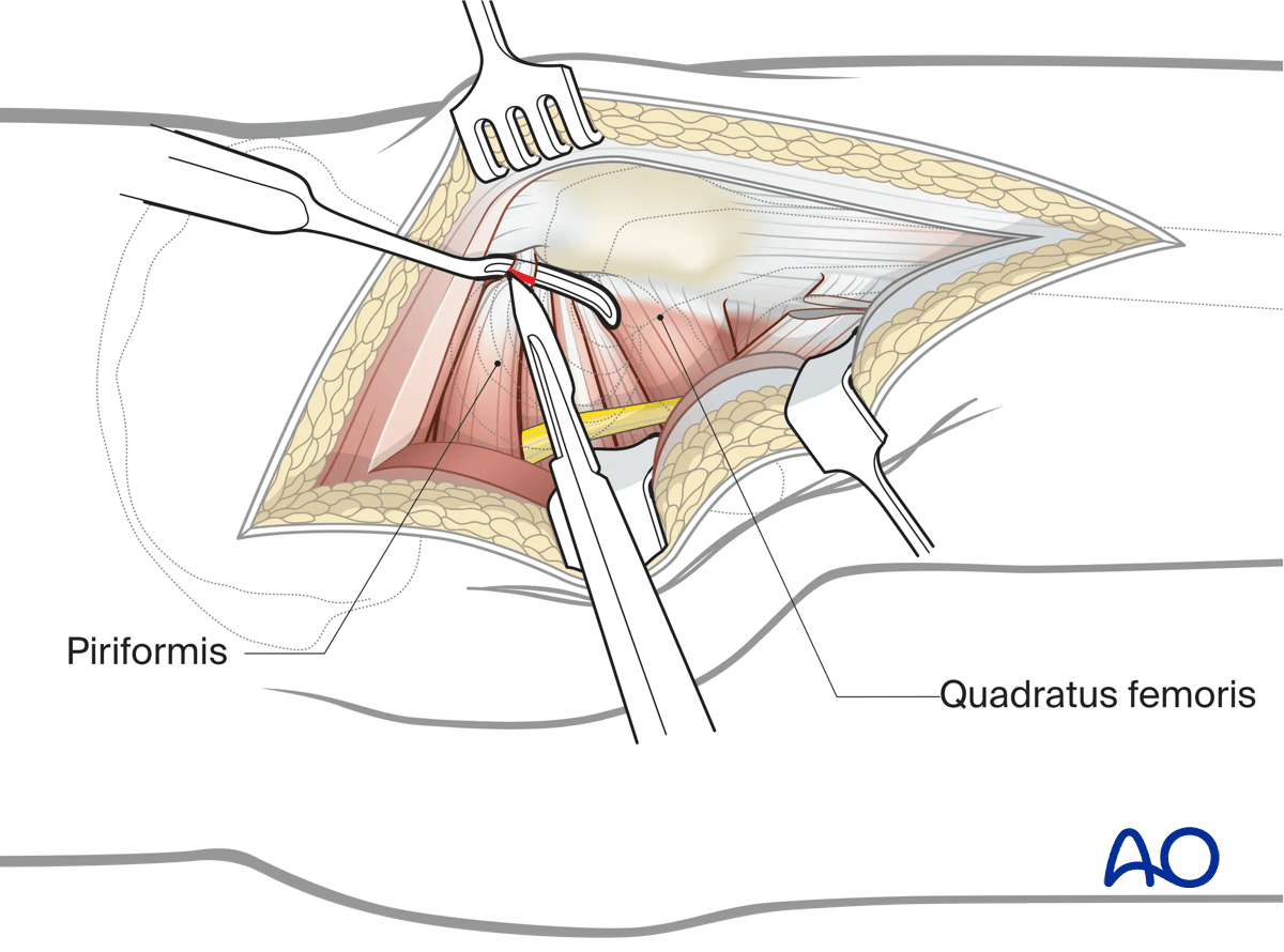 External rotators detachment in a Kocher-Langenbeck approach to the hip