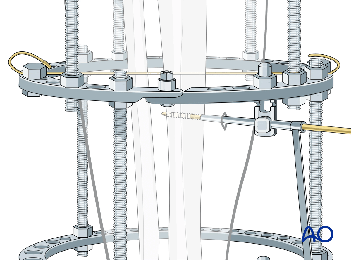 Proximal tibia fracture – ring fixation: Schanz screw mounting with multiparallel pin clamp