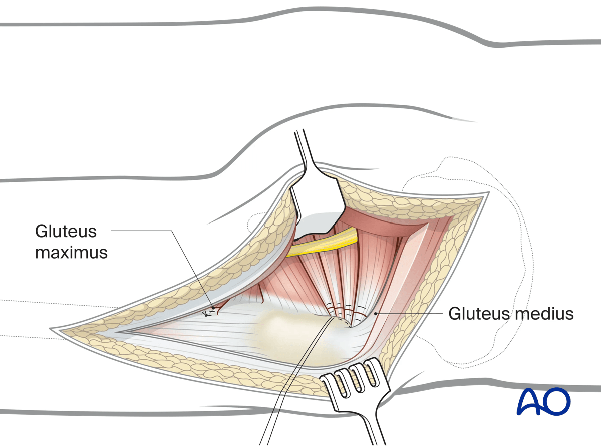 Illustration of Kocher-Langenbeck approach: meticulous debridement, wound irrigation, and tendon reinsertion.