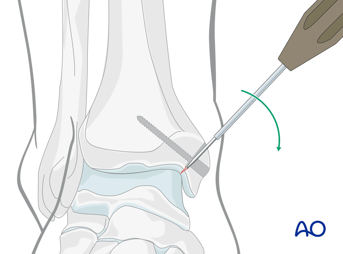 Medial malleolar osteotomy complete medial osteotomy with osteotome to reappose articular surface without loss.