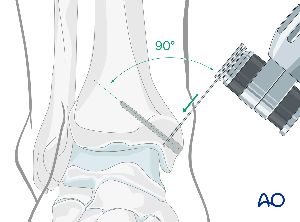 Medial malleolar osteotomy oscillating saw cut at 90° to screws; small K-wire guide for osteotomy placement.