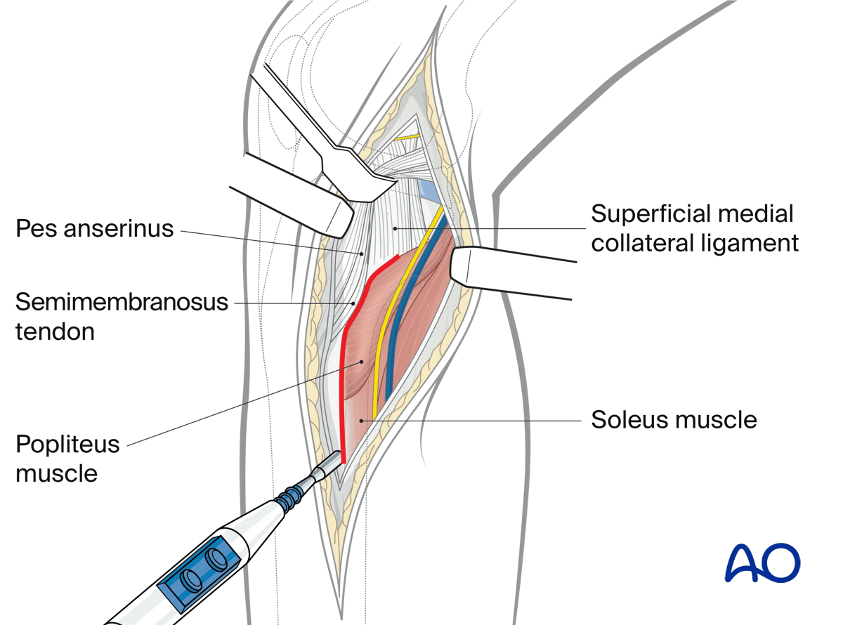 Medial/posteromedial approach to the proximal tibia, access to the posteromedial plateau