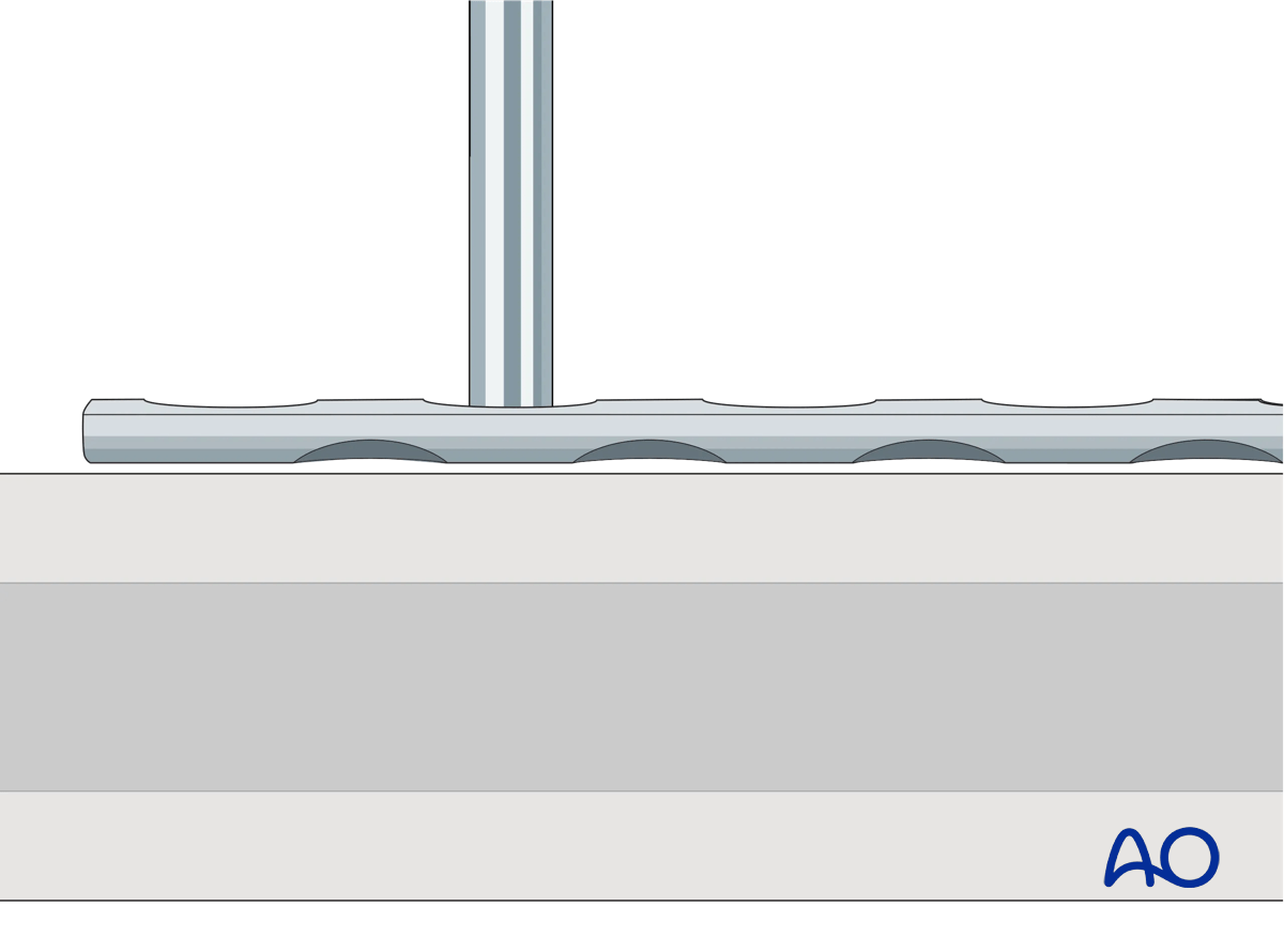 Insertion of drill guide