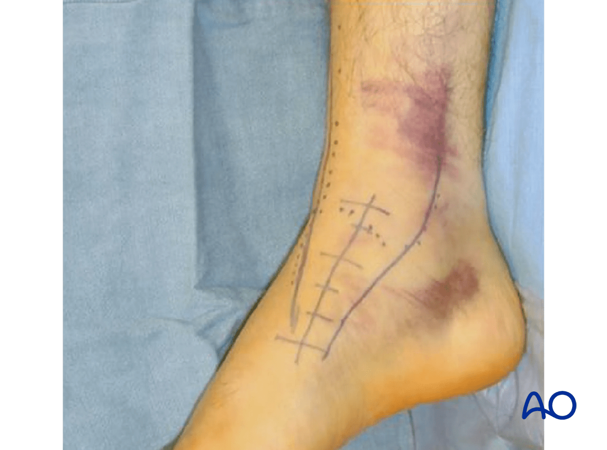 Anteromedial approach preoperative marking of the anteromedial incision