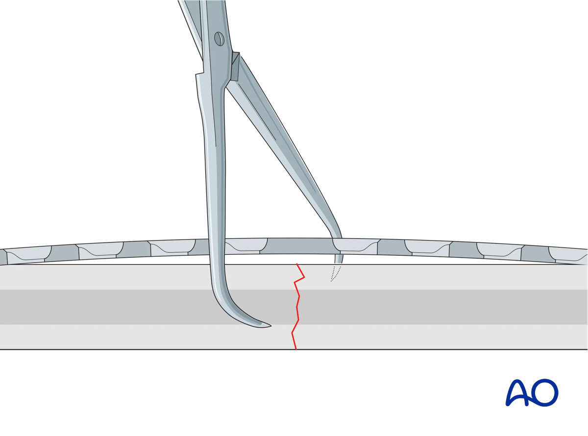 Illustration showing fracture reduction and temporary fixation with forceps, ensuring they do not interfere with the planned plate position.