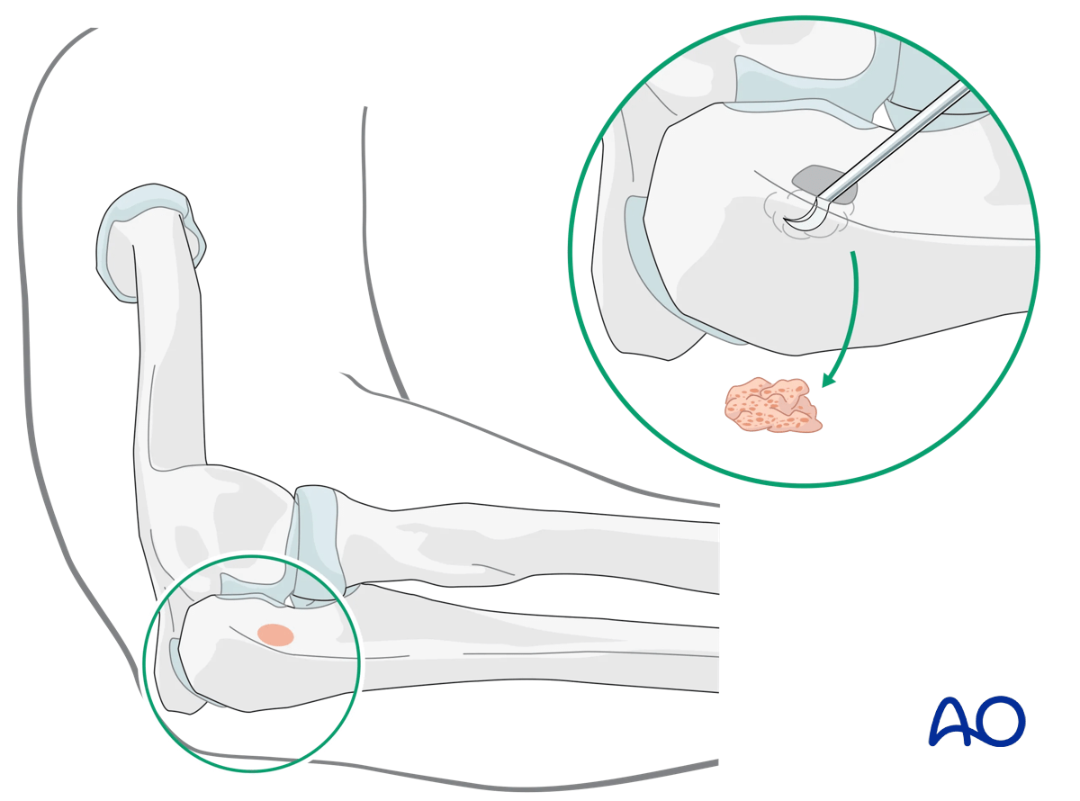 Olecranon harvest site for bone graft