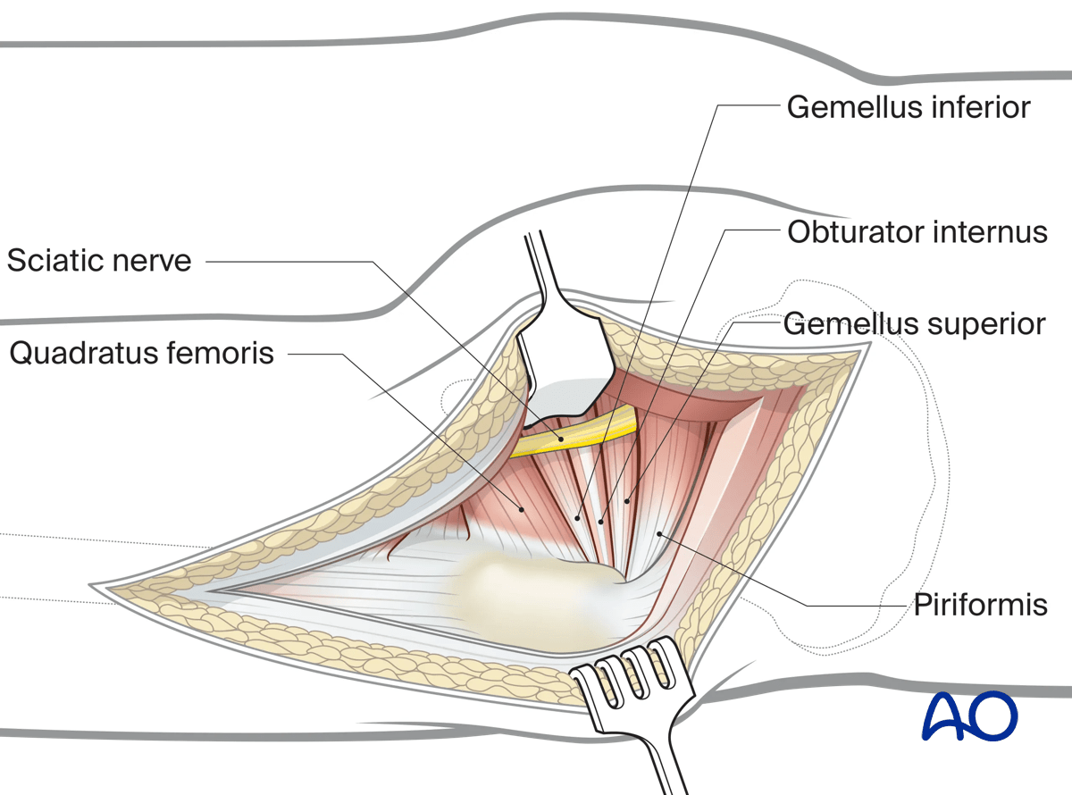 Illustration of Kocher-Langenbeck approach: exposing short external rotators and visualizing sciatic nerve.