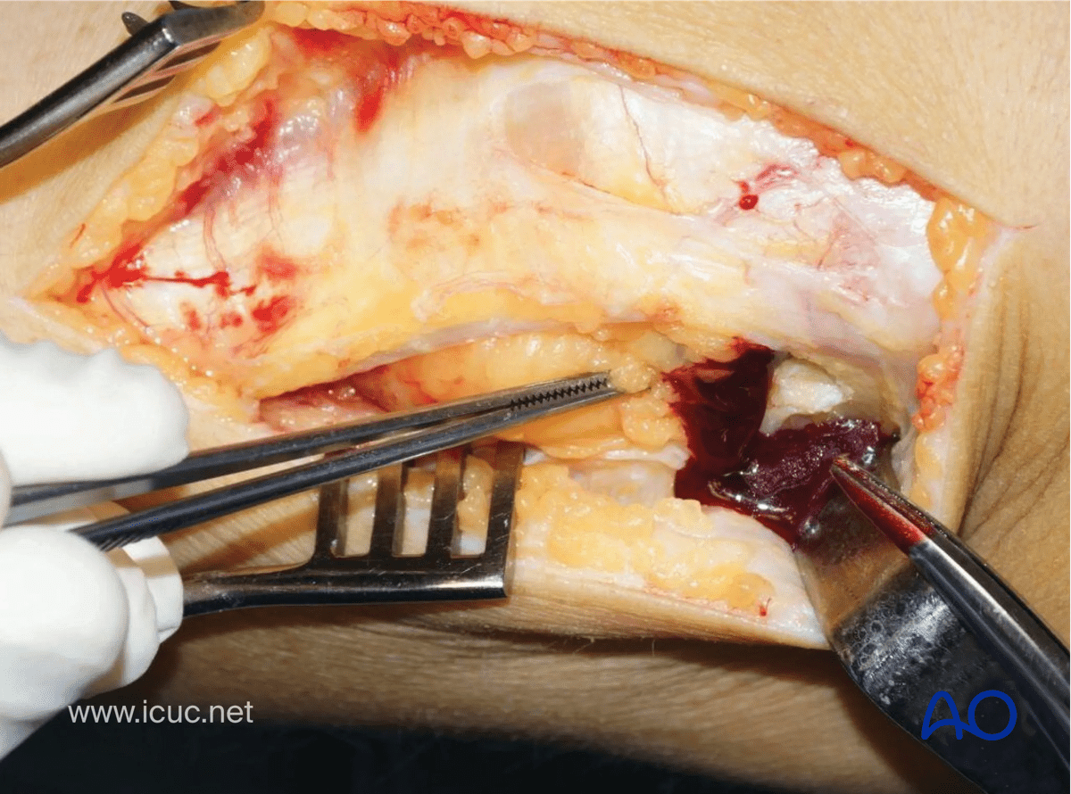 Avulsion of tibial spine - the medial parapatellar retinaculum is opened and the joint capsule is incised