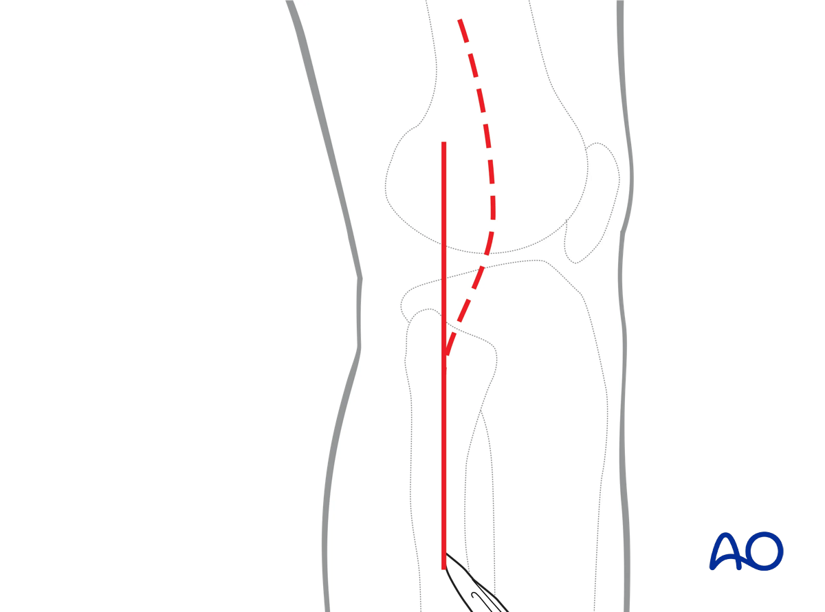 Proximal tibia: Straight lateral approach, skin incision