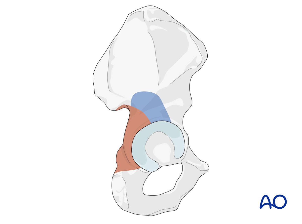 Illustration of Kocher-Langenbeck approach: enhancing exposure with trochanteric osteotomy, showing standard and additional areas.
