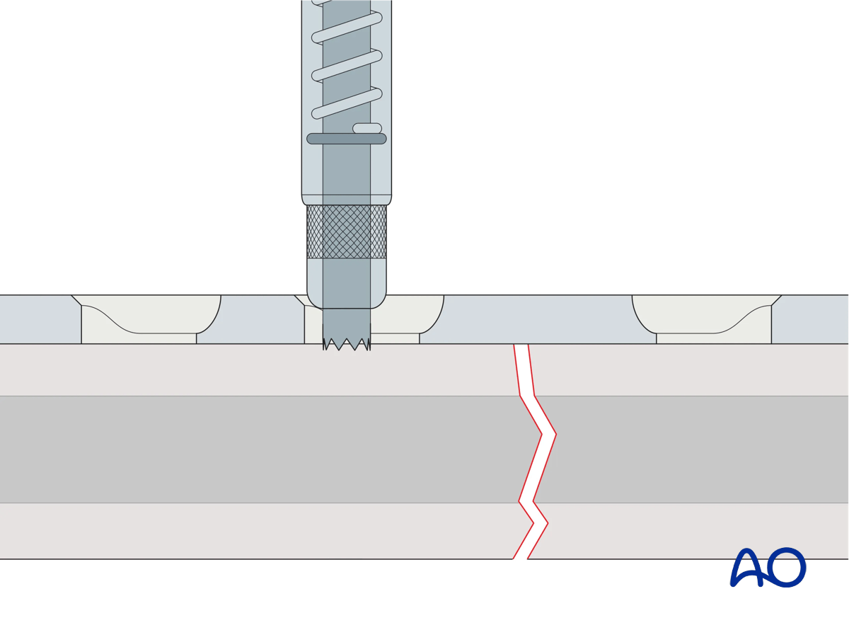 universal spring-loaded DCP drill guide