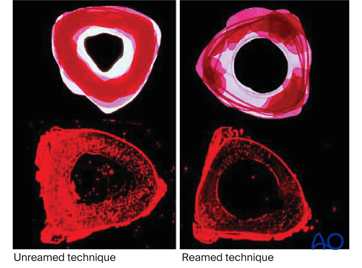 Suprapatellar intramedullary nailing,