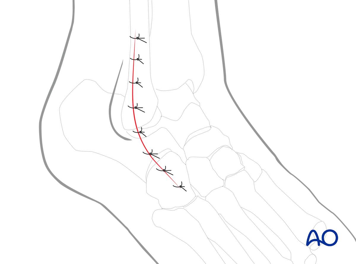 Lateral malleolar osteotomy close approach in layers using deep sutures and skin sutures