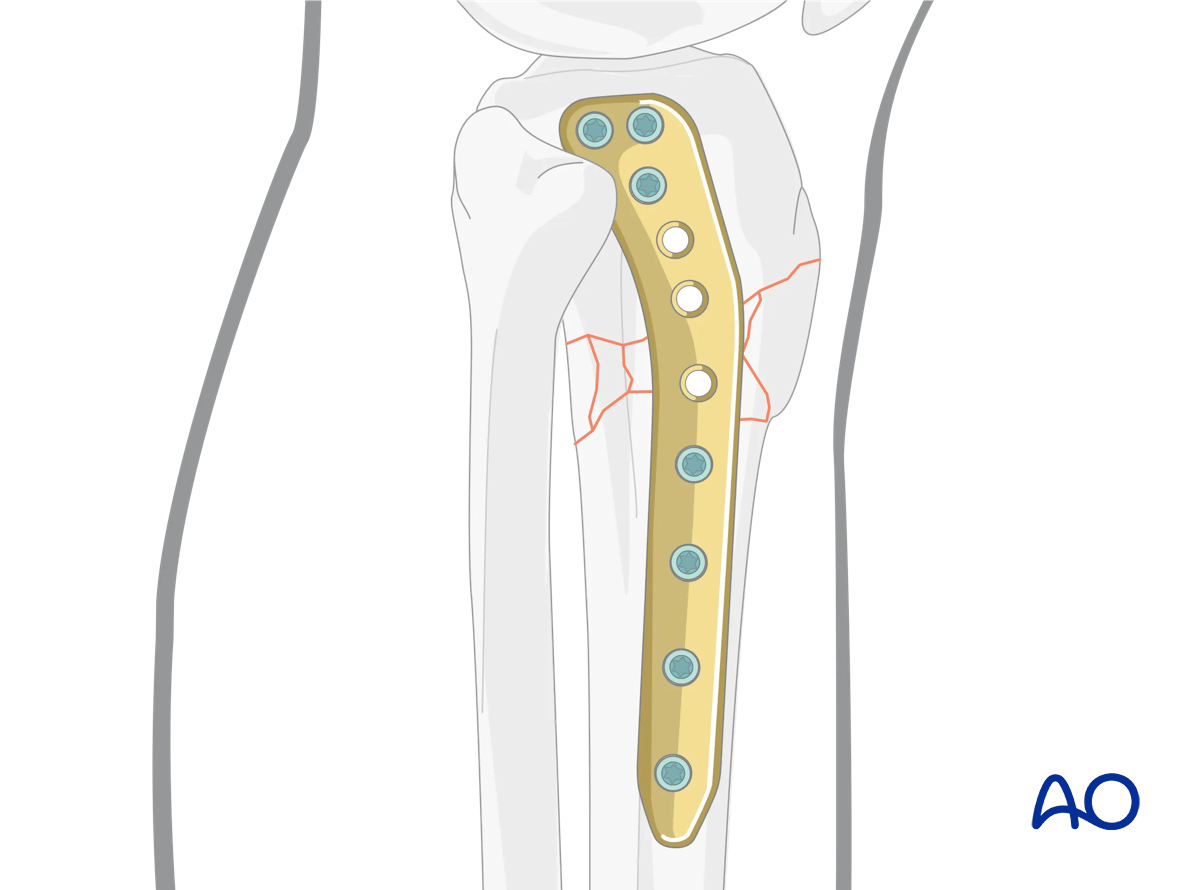 Proximal tibia: Wedge or multifragmentary extraarticular fracture Angular stable plating – principles