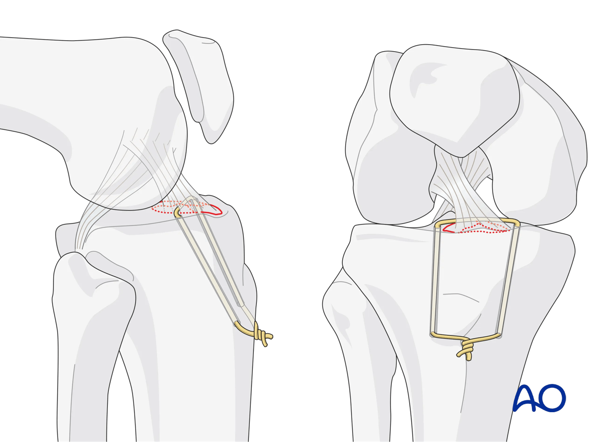Extraarticular fracture, avulsion of tibial spine: fixation