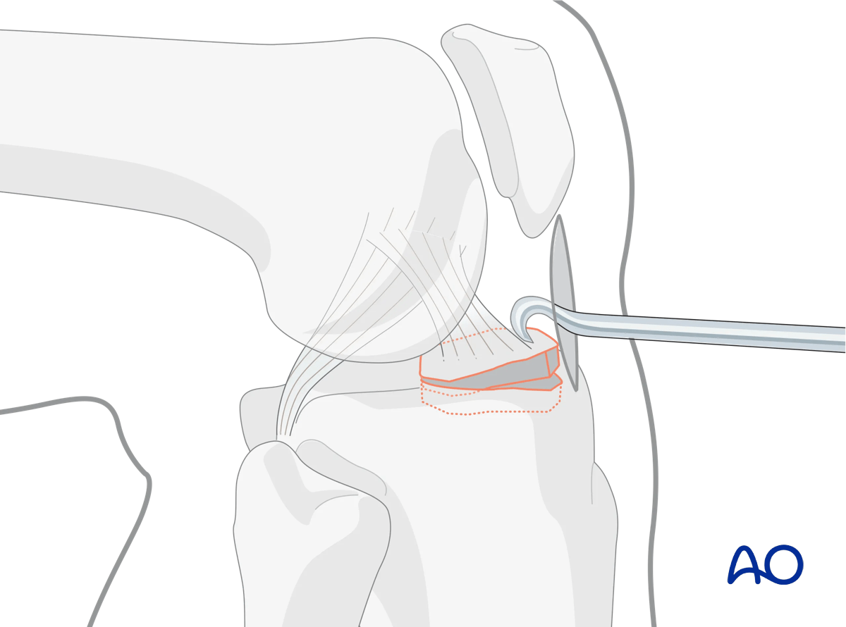 Extraarticular fracture, avulsion of tibial spine – reduction