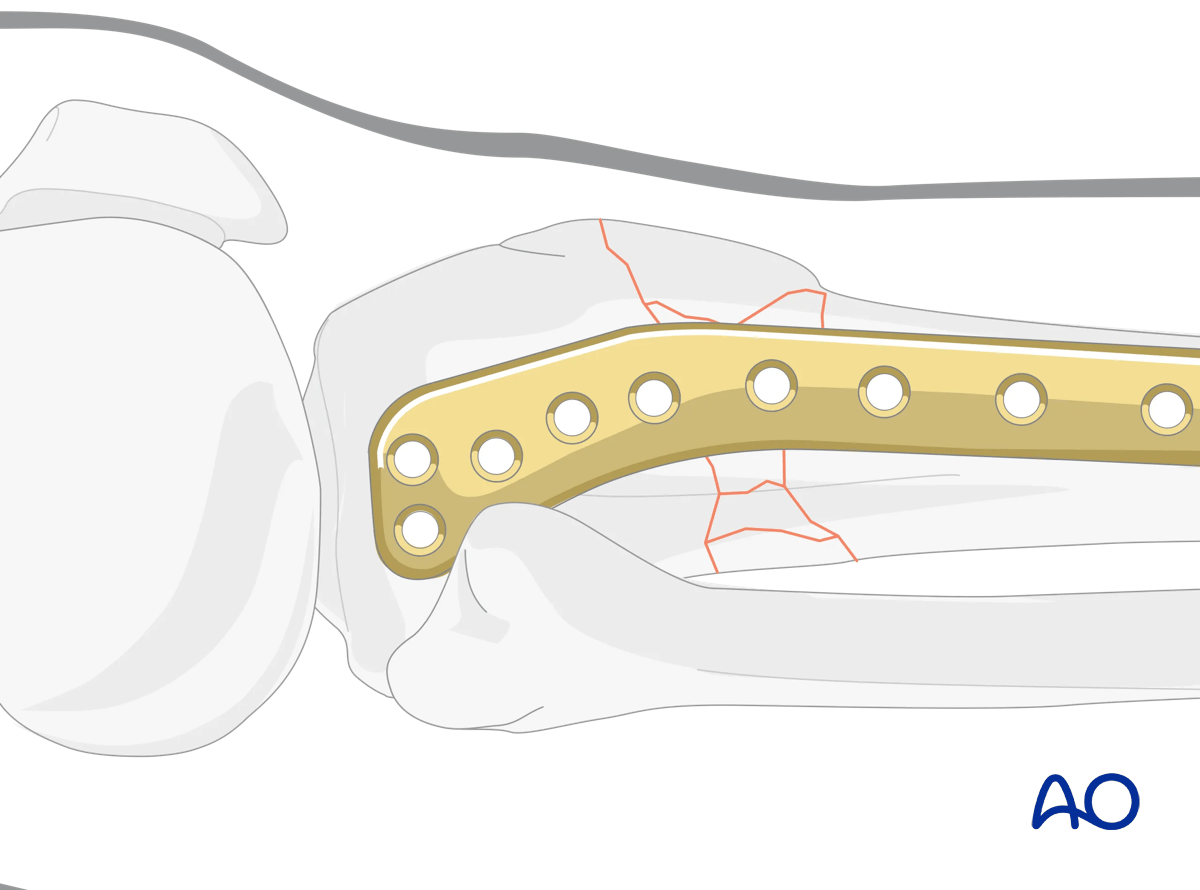 Proximal tibia: Wedge or multifragmentary extraarticular fracture Angular stable plating – plate positioning