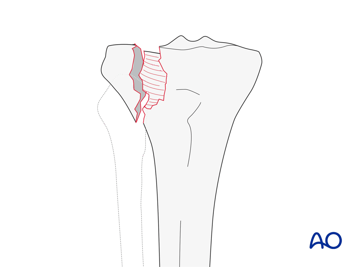 Lateral plateau fracture (AO/OTA 41B3.1)