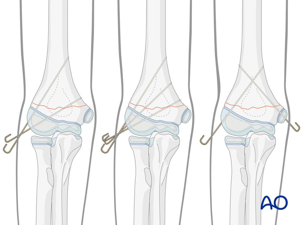K-wire fixations of a supracondylar fracture of the pediatric distal humerus