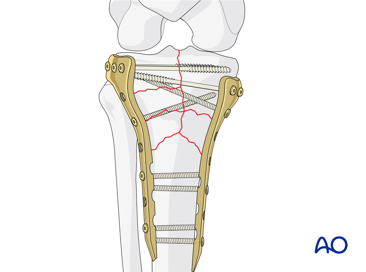 Proximal tibia: Complete simple articular fracture with fragmentary metaphyseal components: final construct