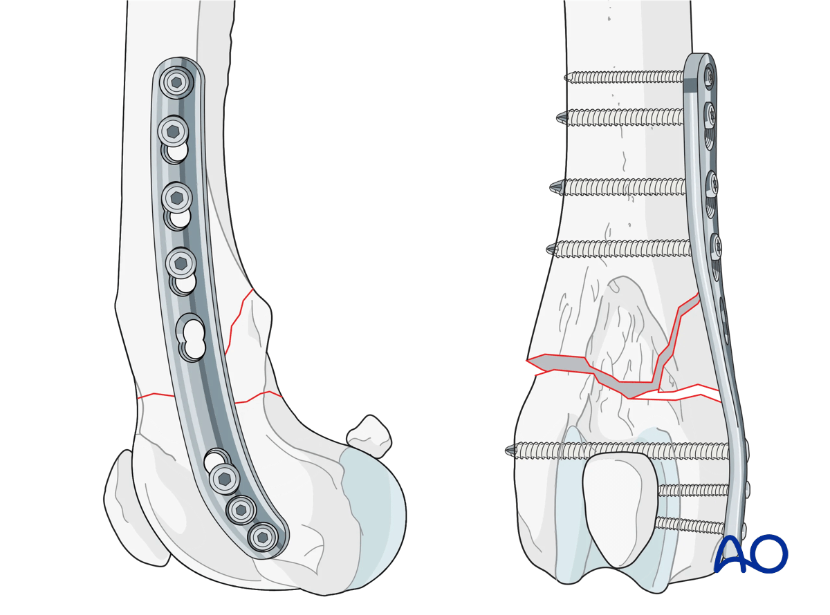 Plate for fixation of distal femoral osteotomy