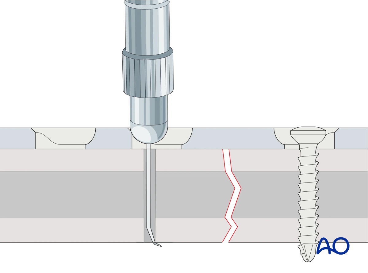 Determination of screw length