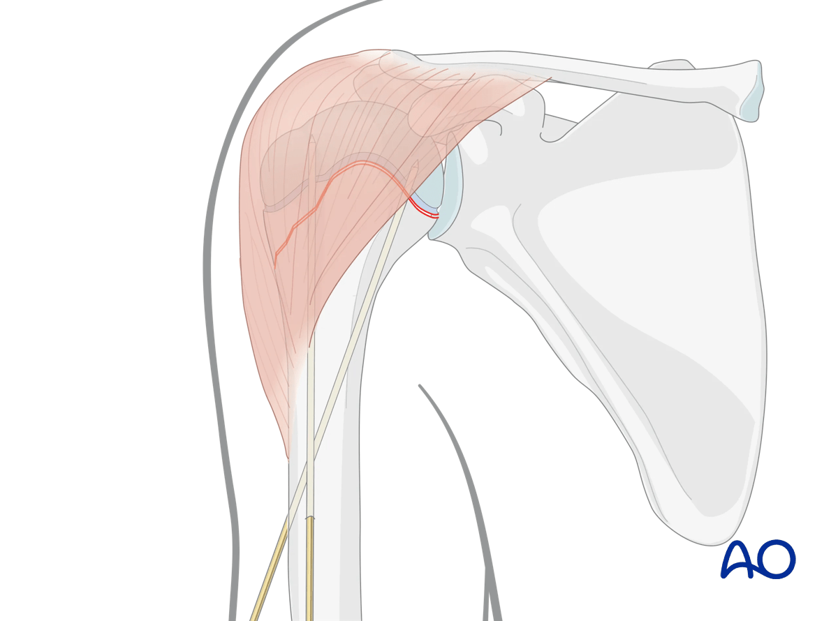 K-wire insertion for proximal subcapital humeral fractures