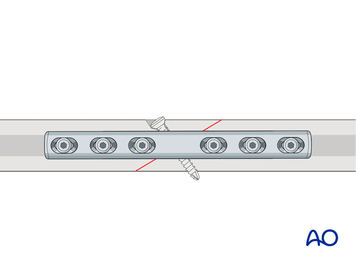 Fixation of an oblique diaphyseal fracture with lag screw and neutralization plate