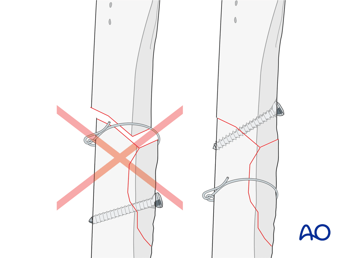 Placing cerclage wires on a short oblique fracture will generate larger shear forces, causing loss of reduction, the fracture to shear, and collapse