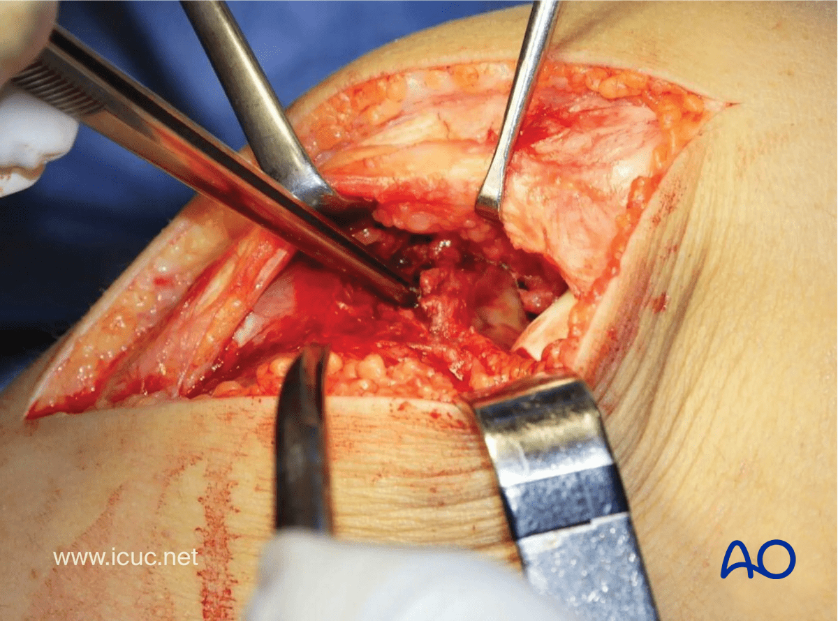 Avulsion of tibial spine - a pair of forceps in the fracture gap below the tibial spine