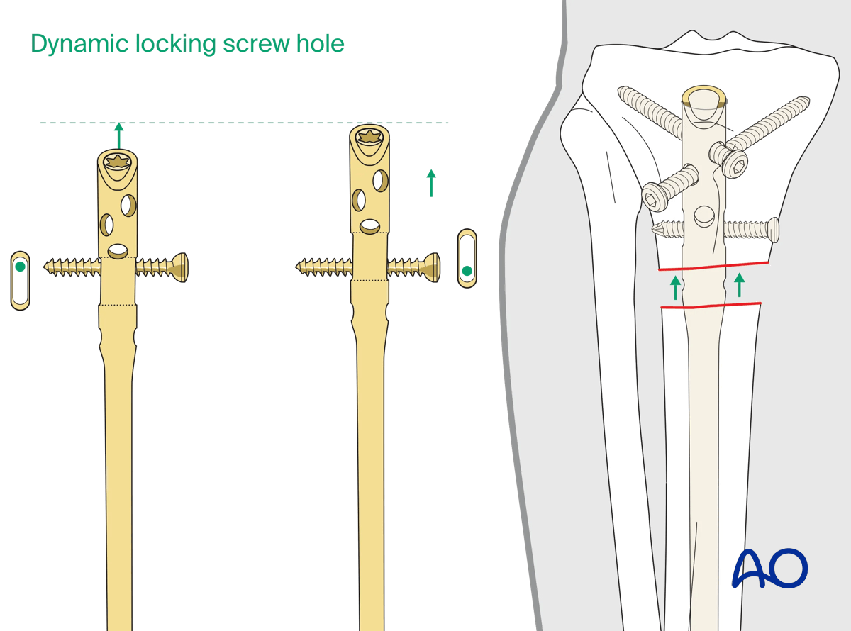 Suprapatellar intramedullary nailing, locking screws