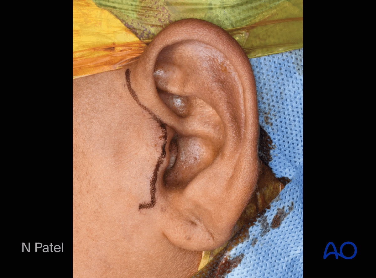 Endaural approach to condyle: Infiltrate local anesthetic or physiologic solution with a vasoconstrictor for hemostasis and incise the skin following the incision outline.
