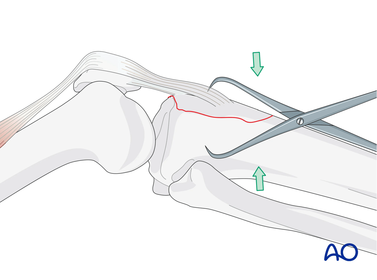Avulsion of tibial tubercle: Reduction with clamp