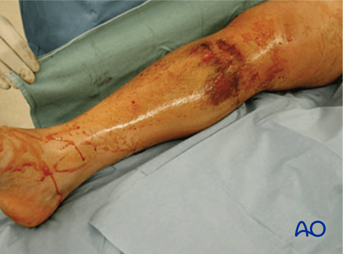 Bicondylar plateau fracture with significant soft-tissue compromise