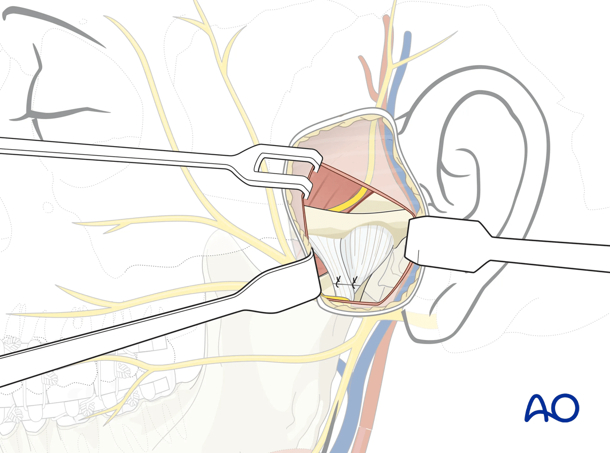 Endaural approach to condyle: If the temporomandibular joint capsule has been incised to access the condylar head, it must be closed as the first step