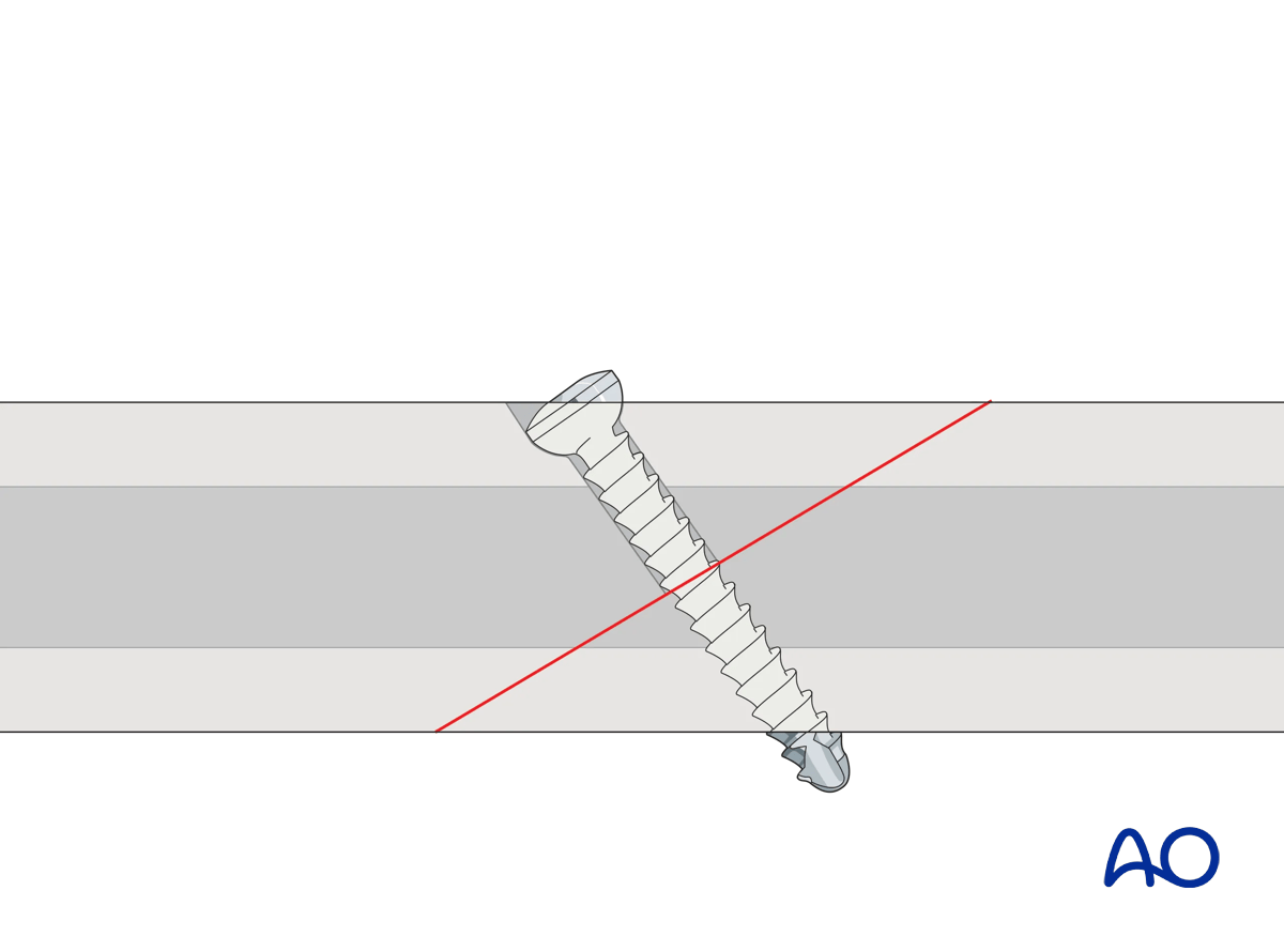 Self-tapping screw inserted