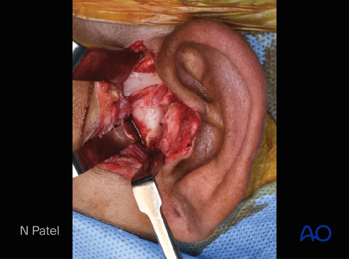 Endaural approach to condyle: The temporomandibular joint capsule is incised horizontally to expose the condylar head