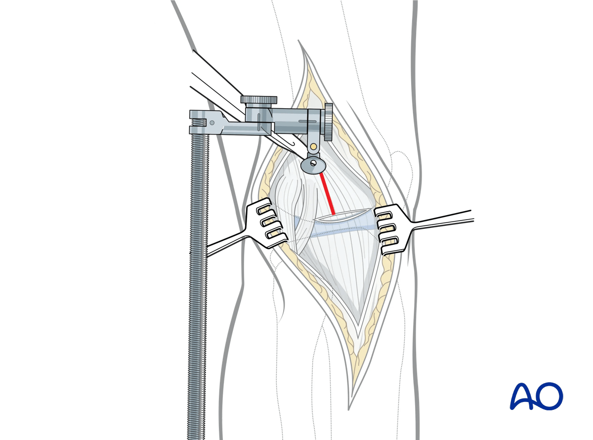Extended anterolateral approach to the proximal tibia: a vertical arthrotomy is carried out above the meniscus anterior to the lateral epicondyle