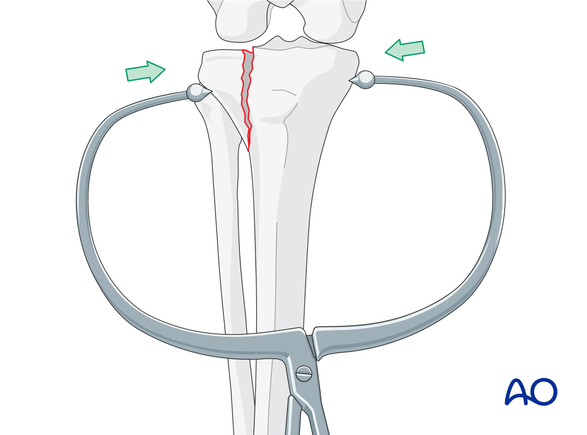 Proximal tibia lateral plateau split fracture – reduction with clamps