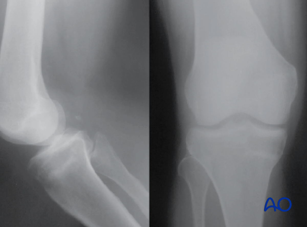 Proximal tibia: anatomy